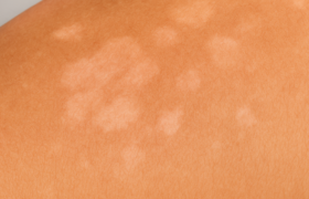 Pitiriasis Versicolor